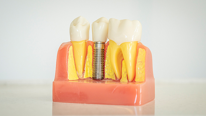 Feste dritte Zähne an einem Tag (All-on-4®)