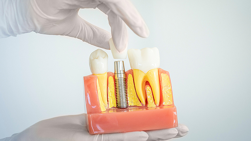 Navigierte Implantologie